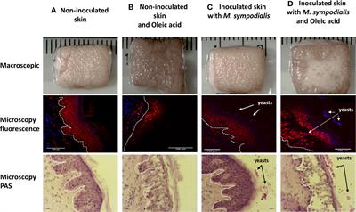 Host Responses in an Ex Vivo Human Skin Model Challenged With Malassezia sympodialis